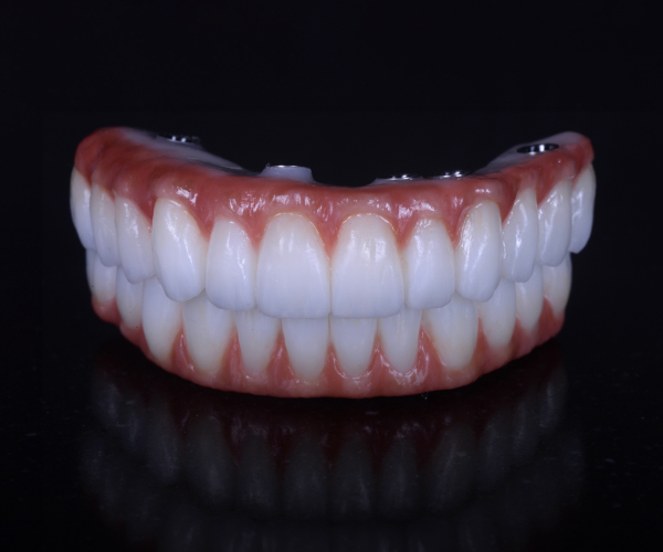 full mouth restoration p