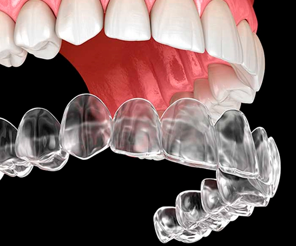 invisalign-metodo-dental-2