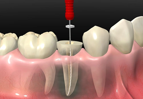 endodontics